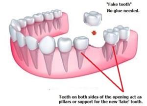 TEETH REPAIR