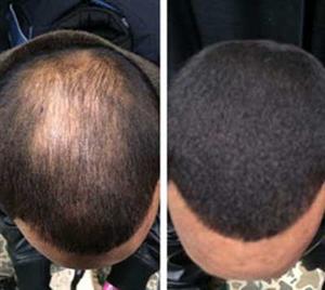 100 Effective Natural Bald Head Treatment Cream To Regrow Hair On